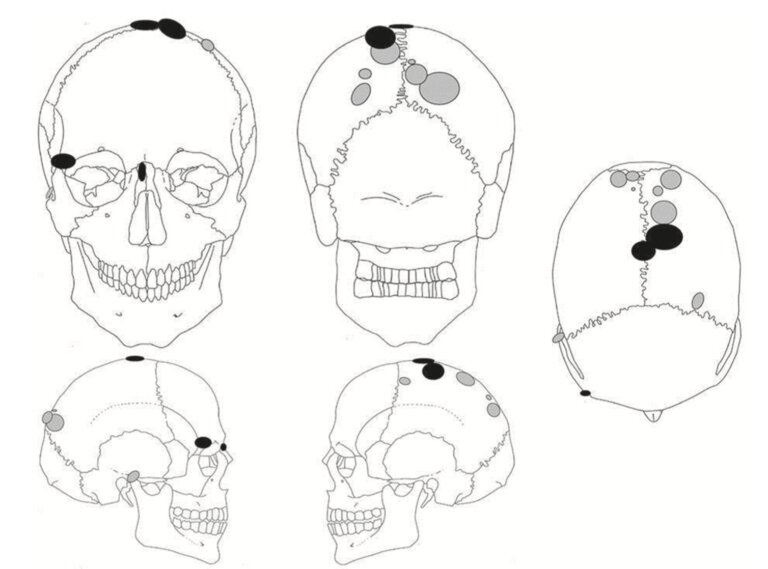 In an 8,000-year-old Burial Archaeological Site in Sweden, Human Skeletons Mounted on Stakes Were Discovered.