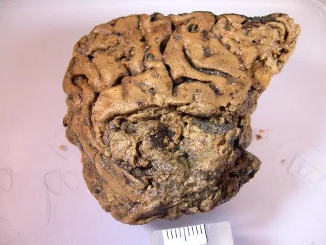 Secrets of an astonishingly well-preserved 2,600-year-old human brain