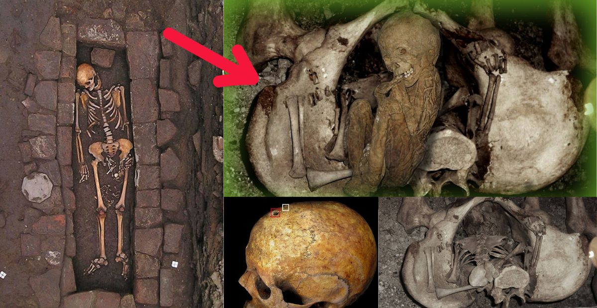 This Medieval Mother Had a Gruesome 'Coffin Birth' After Medieval Brain Surgery