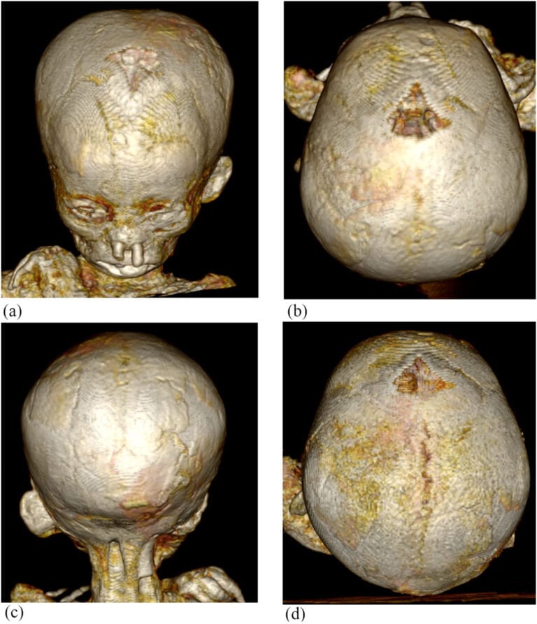 Child Mummies Show High Rates Of Anemia