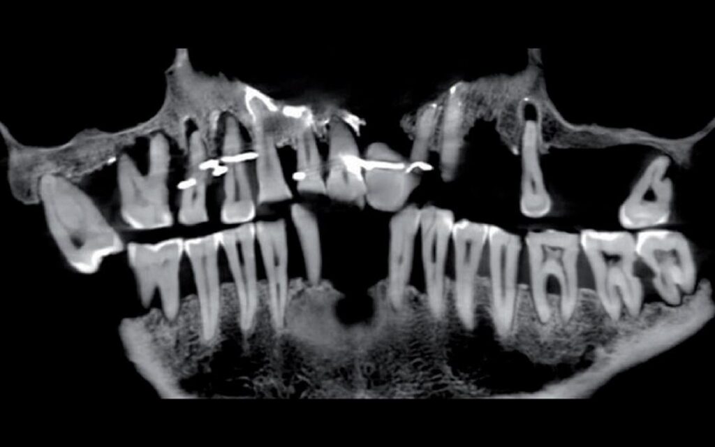 Frenchwoman’s Gold Dental Work 