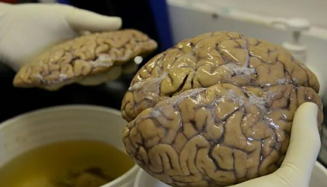 Old Brain Discovered in England: The Iron Age