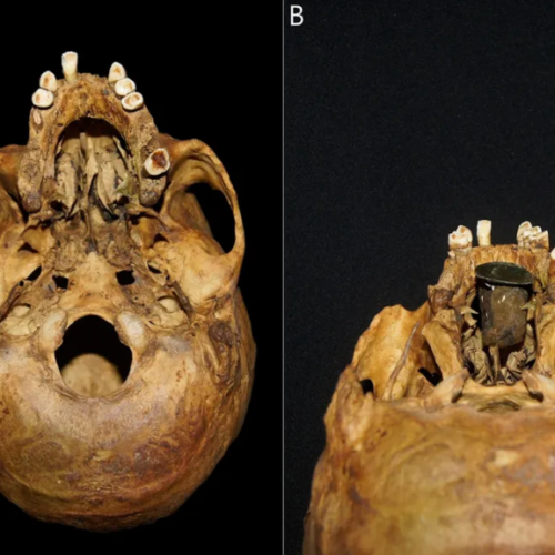 300-Year-Old “Exceptional” Gold and Copper Prosthesis Discovered in Poland