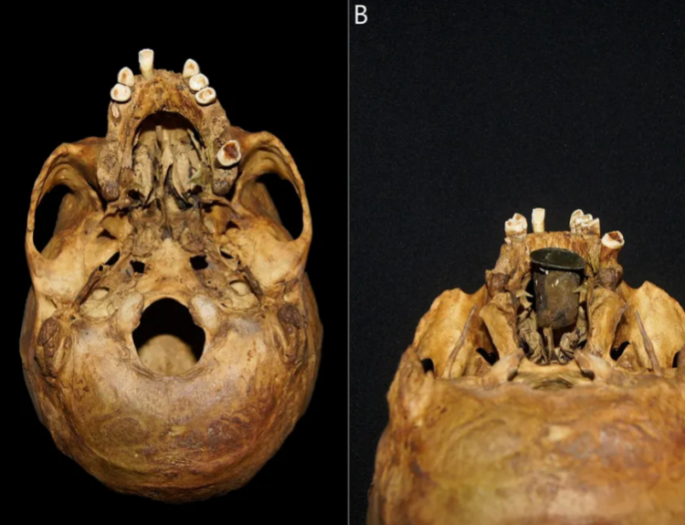 300-Year-Old “Exceptional” Gold and Copper Prosthesis Discovered in Poland