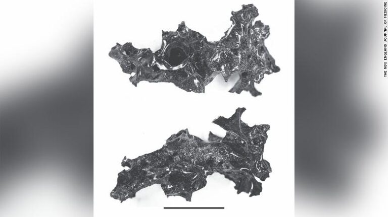 Mount Vesuvius Eruption Turned a Victim’s Brain Into Glass